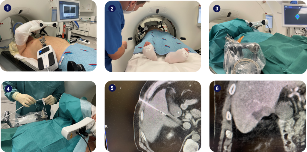 Step-by-step of the standard ablation procedure using Micromate™.
