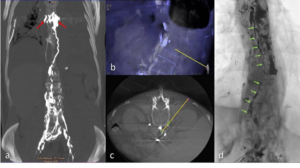 Lymphatic Leak Closure Case Pictures