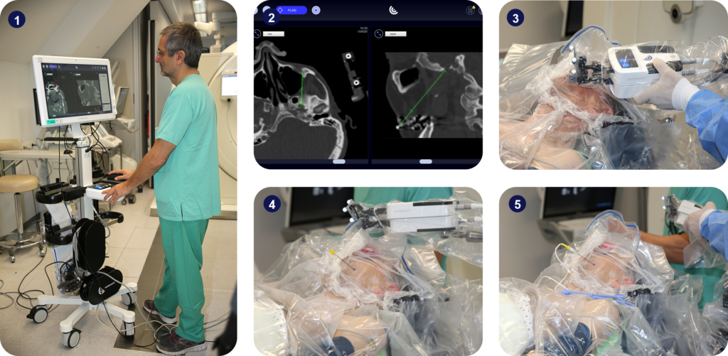 Step-by-step of a trigeminal ablation procedure using Micromate™.