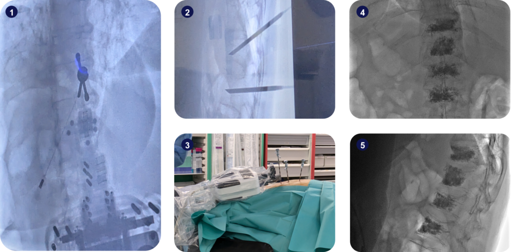 Step-by-step of a CT-guided vertebroplasty using Micromate™